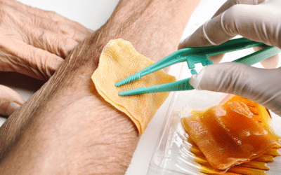 Skin Substitutes vs. Traditional Wound Care: What’s Best for Marietta, GA Patients?